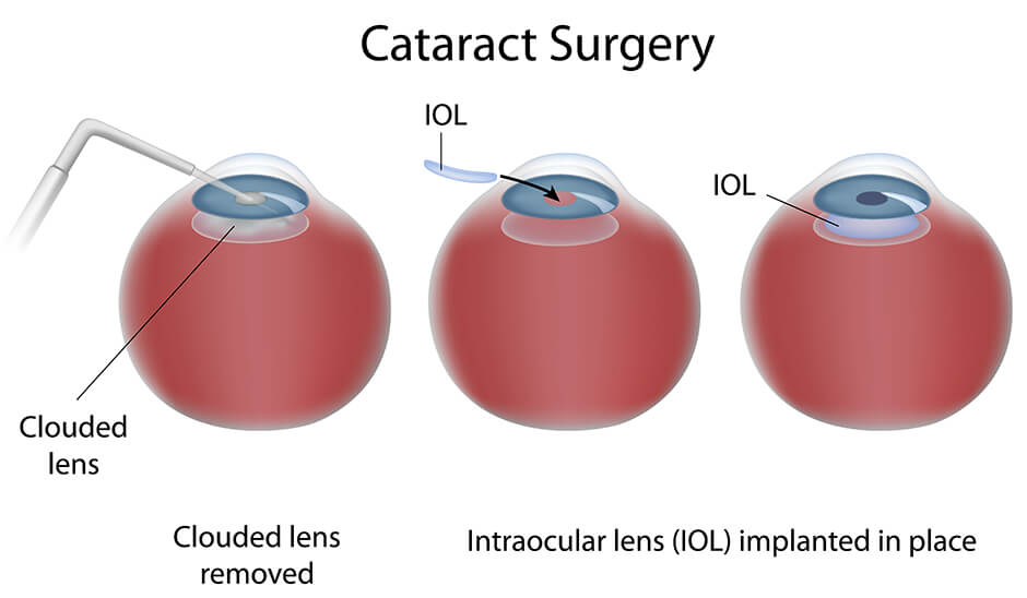 Cataract Surgery Diagram