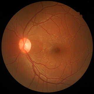 Fluorescein Angiogram:  Normal Eye