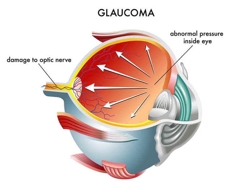 Chart Illustrating How Glaucoma Affects the Eye