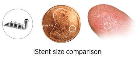 Chart Showing How Small the iStent Is on a Penny and a Finger