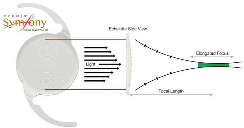 Tecnis Symfony Lens